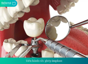 Tien hanh cay ghep implant