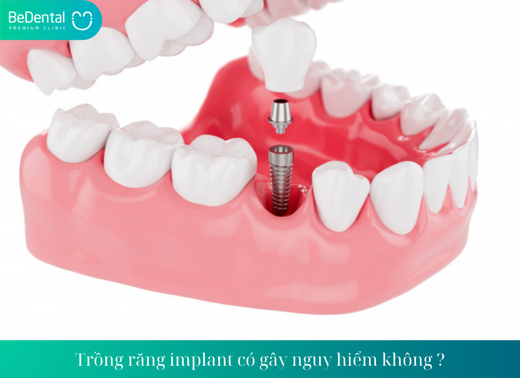 Trong rang implant co gay nguy hiem khong