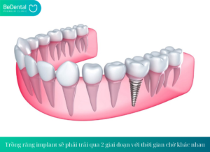 Trong rang implant se phai trai qua 2 giai doan voi thoi gian cho khac nhau