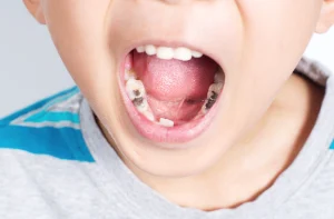 trẻ ăn kẹo bị sâu răng