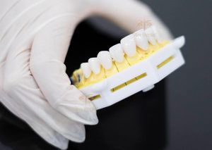 Làm cầu răng sứ hay bị viêm lợi là do đâu và cách điều trị