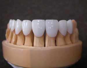 Răng toàn sứ Cercon có đến 16 tone màu để lựa chọn