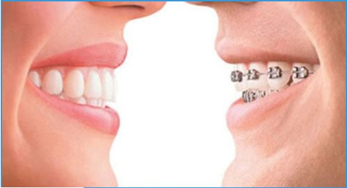 Bọc răng sứ có nên niềng răng không?những điều cần nên biết