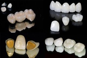 Làm răng giả bằng răng sứ kim loại thường