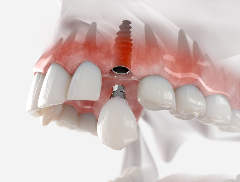 Sau Khi Nhổ Răng Bao Lâu Thì Trồng Implant Được? – Thời Điểm NàoThích Hợp Để Trồng Răng Implant
