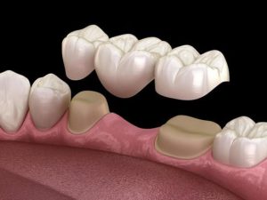 Trường hợp làm cầu răng sứ có thể niềng răng được – Răng giả có niềng được không