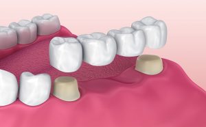 Kinh nghiệm chọn và cách nhận biết các loại cầu răng