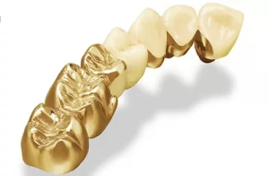 Dù làm từ chất liệu nào thì răng vàng giả, răng kim cương hay răng titan đều có ưu nhược điểm riêng