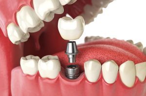 Làm răng Implant cho người già bị mất răng
