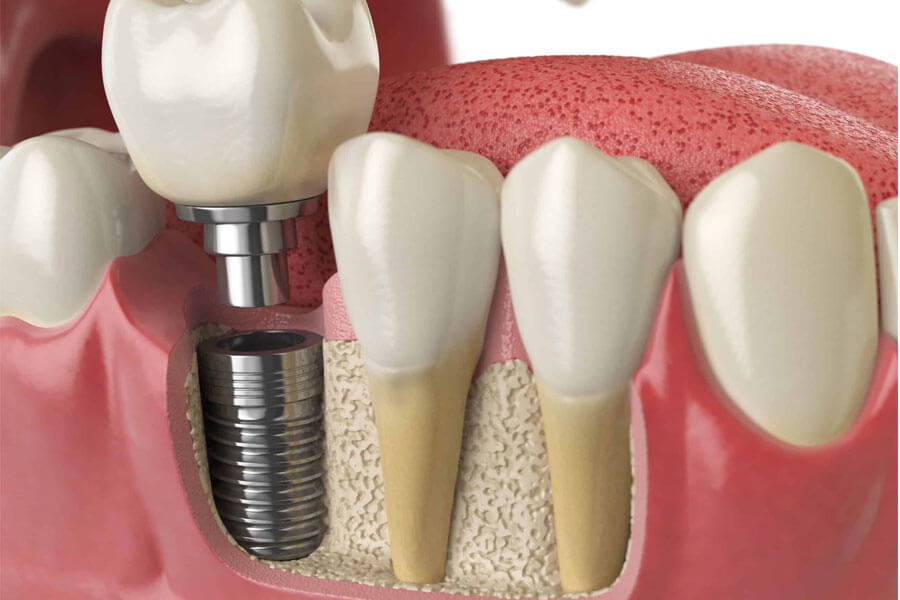 Trồng răng bằng cách implant là gì ?