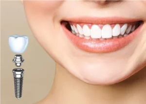 Ưu điểm vượt trội của làm răng Implant