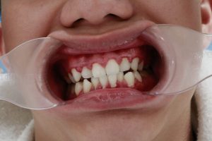 Làm cầu răng sứ hay bị viêm lợi là do đâu và cách điều trị