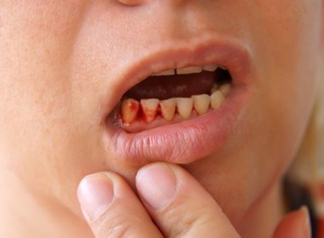 Nguyên nhân nhổ răng khôn không cầm máu
