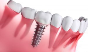 Ưu điểm thực hiện trồng implant ngay sau khi nhổ răng
