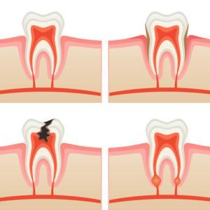 Bị đau răng cấm phải nên làm gì?Nguyên nhân,cách điều trị