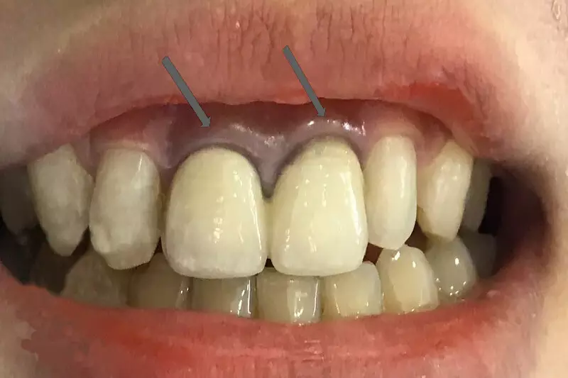 Làm răng sứ kim loại sẽ xuất hiện viền đen sau 1 thời gian sử dụng