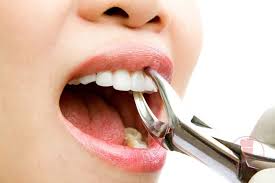 Niềng răng có cần nhổ răng không?Nhổ răng nguy hiểm không?