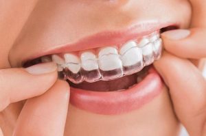Niêng răng trong suốt có đau nhức không?Giá bao nhiêu?