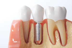 Làm răng cấm giả bằng phương pháp cấy ghép răng implant