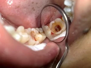 Cần đến bác sĩ nha khoa để được xử lý vết nhiễm trùng ổ răng