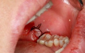 4 biến chứng nguy hiểm khi nhổ răng khôn quên cắt chỉ
