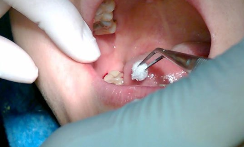 Nhổ răng khôn xong có lỗ là hiện tượng bình thường, không gây nguy hiểm gì quá lớn