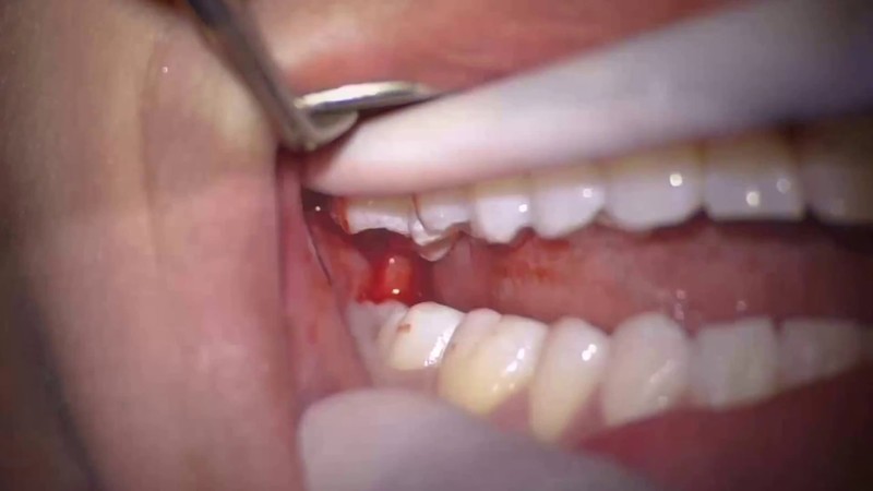 Quá trình phục hồi sau khi nhổ răng khôn