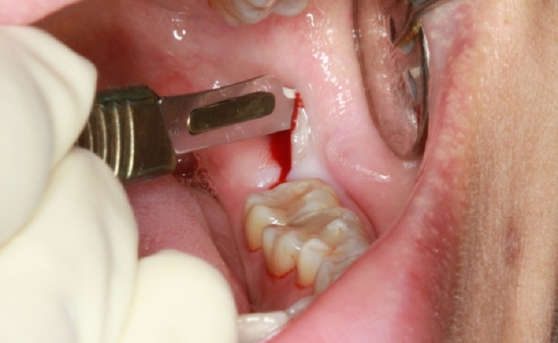 Tùy từng trường hợp bác sĩ sẽ quyết định nhổ răng khôn có cần khâu không