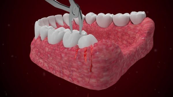 Các cách nhổ răng cấm tại nhà liệu có nguy hiểm ?