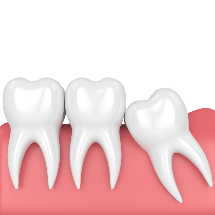 Nhổ răng khôn xong có lỗ là do để lấy được răng, bác sĩ cần phải rạch nướu và lỗ hổng tương ứng với vị trí chân răng vừa nhổ