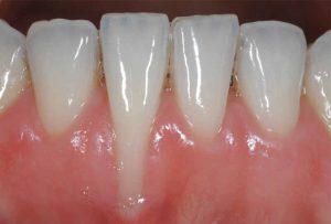 Bị tụt lợi,rớt mắc cài khi niềng răng do đâu-Cách điều trị