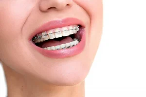 Niềng răng có cần nhổ răng không?Nhổ răng nguy hiểm không?