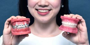 Những trường hợp nào thì cần nên niềng răng?