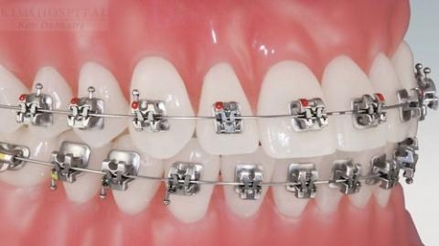 Kinh nghiệm niềng răng cần biết,tìm hiểu các bước niềng răng