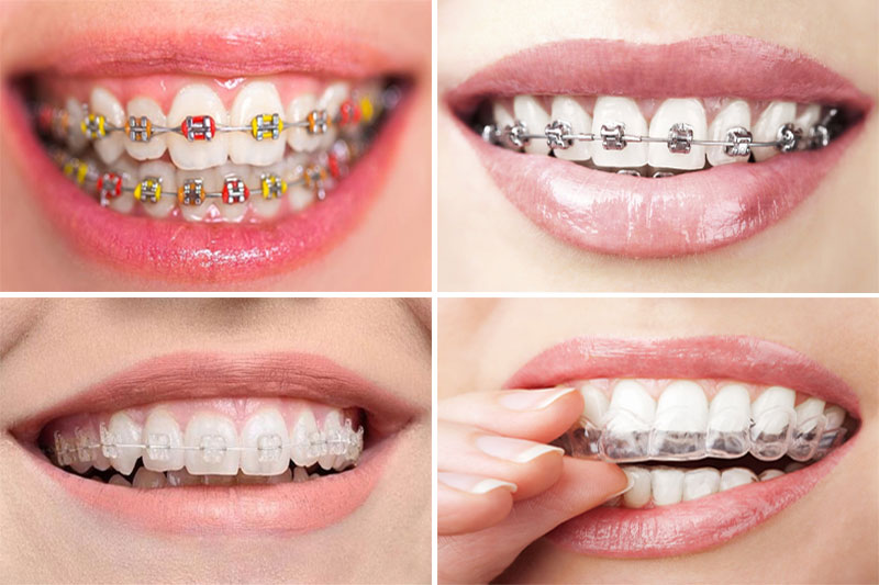 Niềng răng không nhổ răng khôn có thể để lại nhiều hậu quả nghiêm trọng nên cần tư vấn bởi bác sĩ nha khoa