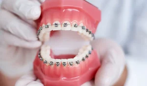 Có nên niềng răng giả không?Trường hợp nào nên và không nên