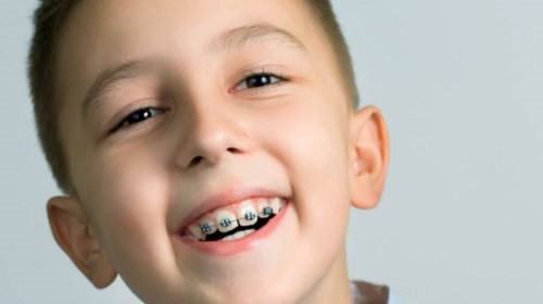 Vì sao nên niềng răng?Độ tuổi nên niềng răng là bao nhiêu?
