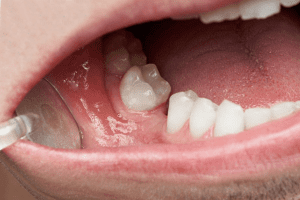 Những trường hợp người già không nên tiến hành trồng răng implant Những trường hợp người già không nên tiến hành trồng răng implant
