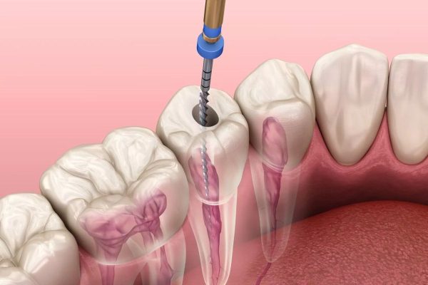 Tìm hiểu về phương pháp lấy tủy răng cấm