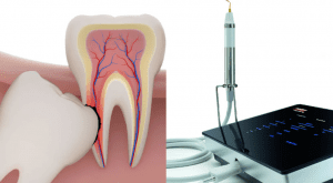 Các trường hợp nên nhổ răng khôn bằng máy piezotome