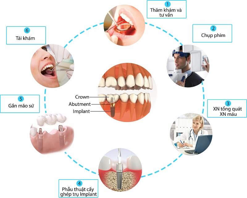 Quy trình trồng răng implant mất bao lâu?