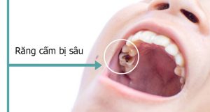 Răng cấm bị sâu là do đâu? Có nên nhổ bỏ không ?