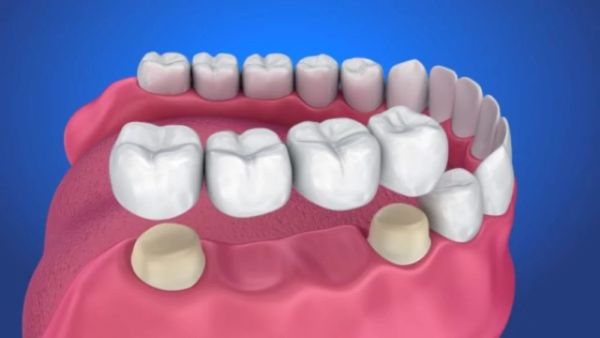 Răng cấm của trẻ 6 tuổi bị sâu phải điều trị như thế nào?