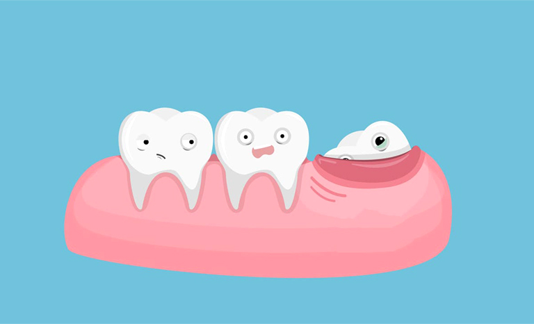 4 yếu tố tác động trực tiếp đến thời gian lành vết thương sau nhổ răng khôn