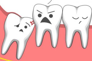 Nhổ răng khôn không đau có đúng không?