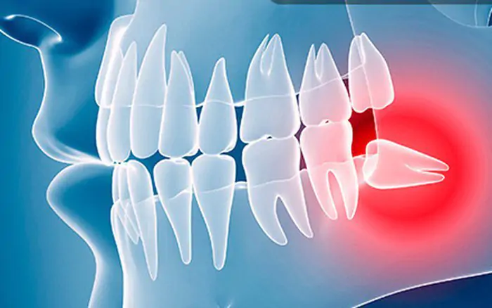 Răng khôn là chiếc răng mọc cuối cùng và tận bên trong góc hàm