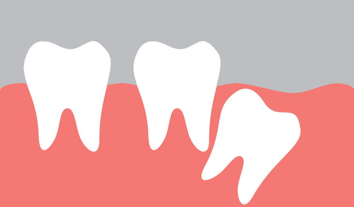Nhổ răng khôn sẽ an toàn, ít xảy ra biến chứng khi bạn tìm đến những địa chỉ nha khoa uy tín