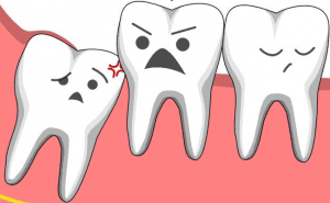 Để biết có nên nhổ răng khôn hay không, bạn nên tìm đến bác sĩ nha khoa để được tư vấn