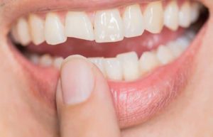 Các biện pháp khắc phục răng giả bị mẻ