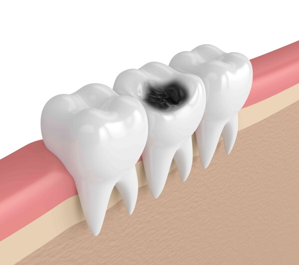 Nguyên nhân sâu răng hàm là gì và cách chữa trị hiệu quả